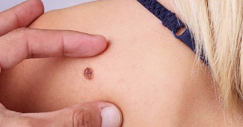 melanoma